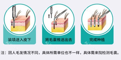 植发过程示意图片