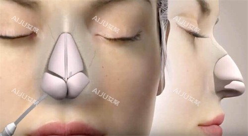 塌鼻梁+圆鼻头显土气?我找深圳王天国医生做鼻综合,2个月变精致,拍照上镜超好看! 塌鼻梁+圆鼻头显土气?我找深圳王天国医生做鼻综合,2个月变精致,拍照上镜超好看!