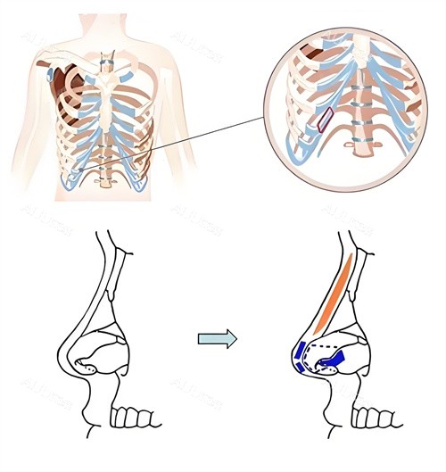 全肋骨隆鼻术手术展示动画图 全肋骨隆鼻术手术展示动画图