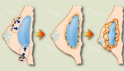 丰胸薄膜挛缩形成示意图 丰胸薄膜挛缩形成示意图