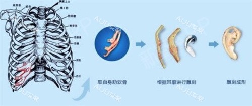 耳再造手术肋软骨雕刻