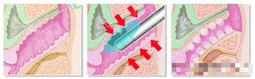 菲蜜丽过程卡通图