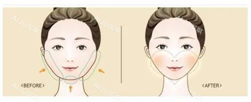 磨骨手术前后的区别 磨骨手术前后的区别