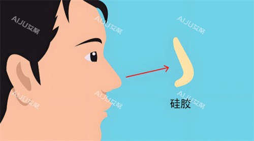 硅胶假体隆鼻