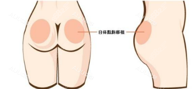 成都哪家整形医院能做臀？成都悦好、后美、莱瑞拉威塑这些整形医院靠谱，臀型做得好！