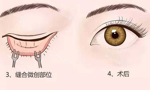 郑州眼袋修复黄军伟修复眼袋靠实力说话,揭秘其技术优势和结果评价分享 郑州眼袋修复黄军伟修复眼袋靠实力说话,揭秘其技术优势和结果评价分享