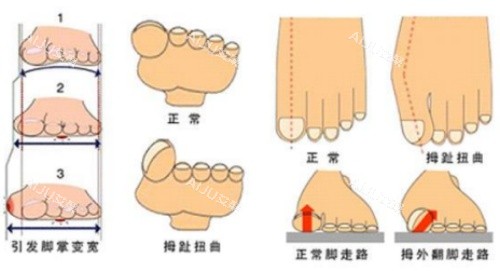 李昕宇医生拇指外翻示意图