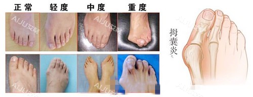 李昕宇医生拇指外翻