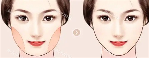 面部吸脂