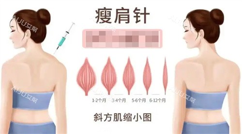 瘦身针瘦斜方肌