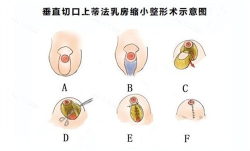 上海华美李健医生缩胸技术很推荐！给我做的缩胸实现从C到A，视觉上瘦了好多