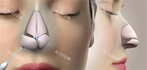 郑州丽天鼻综合鼻骨动画