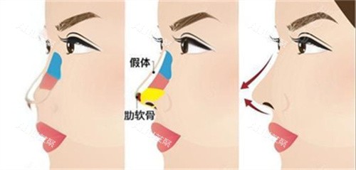 郑州丽天鼻综合术后对比