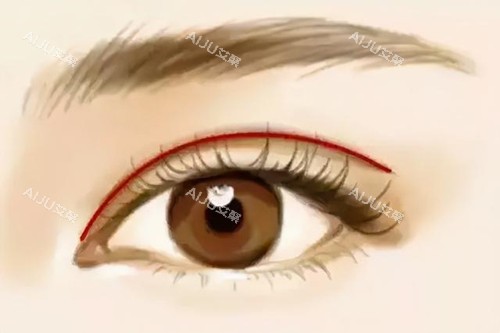 开扇形双眼皮 开扇形双眼皮