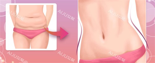 郑州圣熙格兰腹壁成形手术对比图