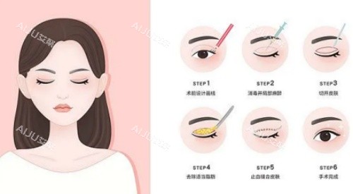 焦作缔莱美拉双眼皮手术示意图