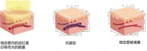 595染料激光治疗过程图解