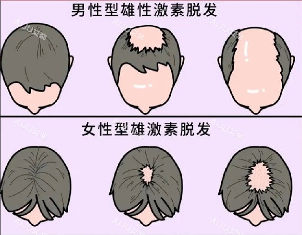 脱发图片