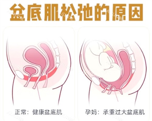 盆肌底松弛的原因