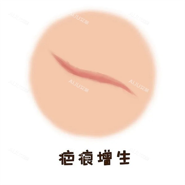 疤痕增生图片