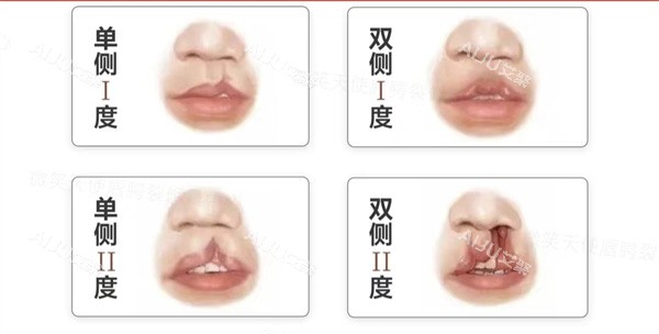 唇裂