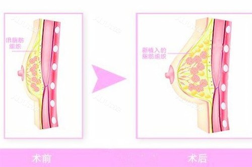 海口鹏爱自体脂肪隆胸图片