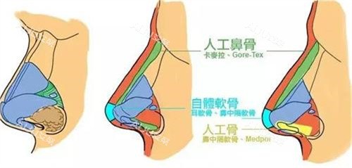 北海美诺隆鼻手术对比