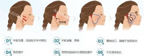 袁强博士微拉美拉皮手术过程图