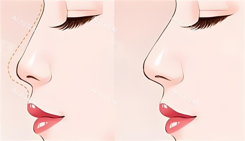 遵义美若瑶光隆鼻前后对比动画图