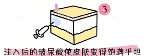 玻尿酸填充原理