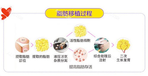 脂肪移植过程