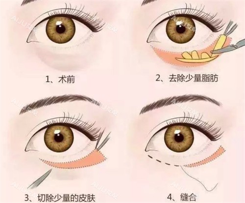 西宁祛眼袋多少钱？25年价目表显示，眼袋失败修复28600起、眶隔脂肪释放术15800起