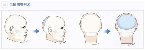 何晋龙peek填后脑勺手术靠谱吗？实力说话20年颅颌面经验，PEEK材料3D打印定制，贴合颅骨术后不移位