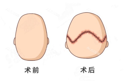 后脑勺整形卡通对比图