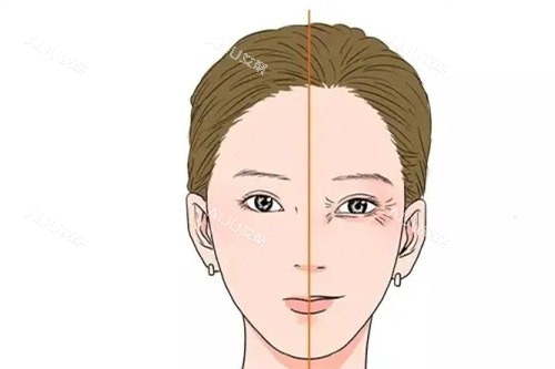 肖庆华医生眼部皱纹.webp
