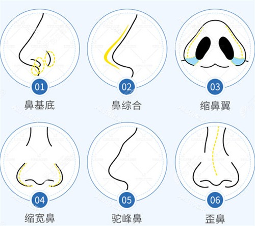 长沙罗阳不同隆鼻技术图解