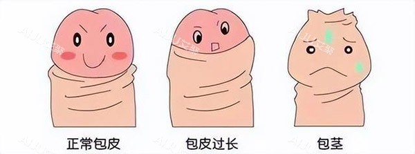 包皮过长
