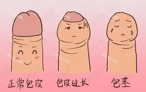 包皮改善手术过程