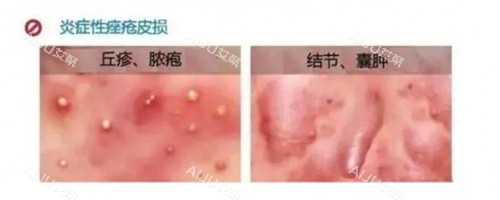 炎症性痤疮照片