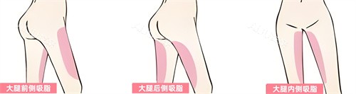 腿部吸脂部位展示动画图