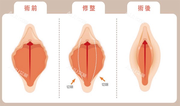 外阴唇切除术前术后