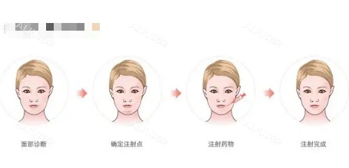骸肌放松注射过程示意图