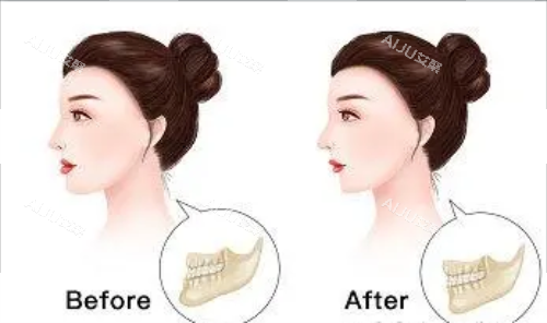 正颌手术后的成效图片 正颌手术后的成效图片