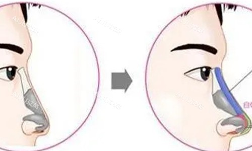 鼻小柱延长的手术示意图 鼻小柱延长的手术示意图