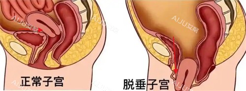 子宫脱垂前后对比