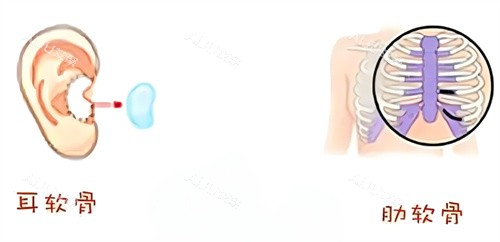 隆鼻耳软骨鼻肋骨鼻取材区别 隆鼻耳软骨鼻肋骨鼻取材区别