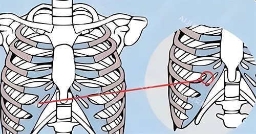 隆鼻肋骨鼻所用肋骨图 隆鼻肋骨鼻所用肋骨图