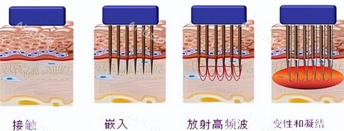 黄金微针操作过程 黄金微针操作过程