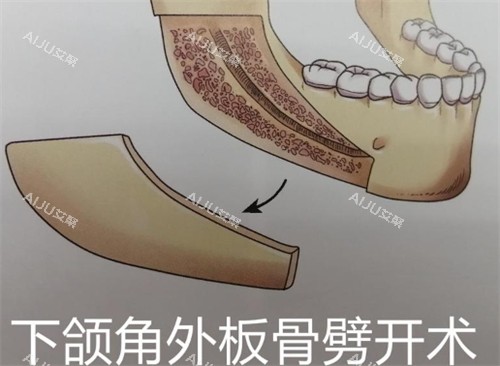 下颌角外板劈开术 下颌角外板劈开术