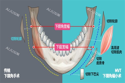 下颌角手术宣传图 下颌角手术宣传图
